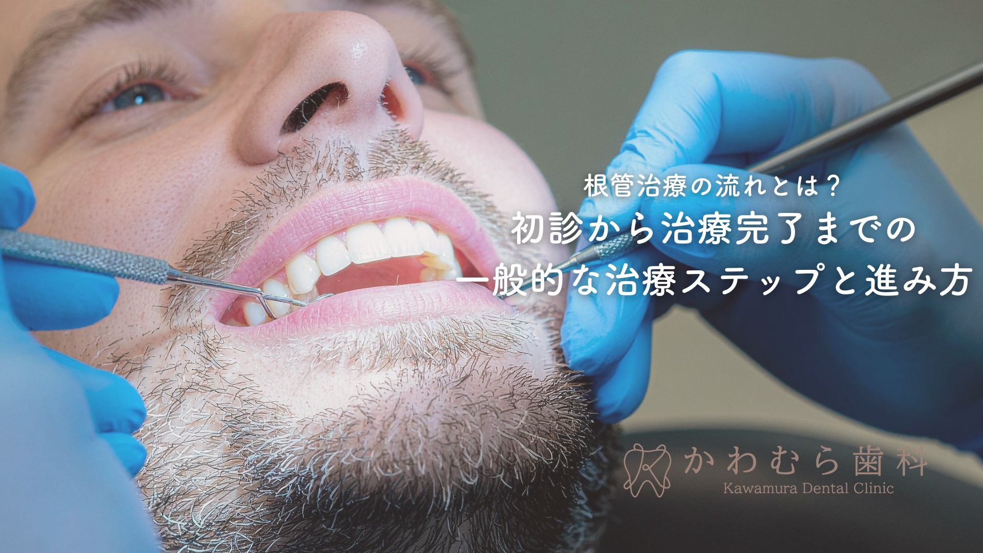 根管治療の流れとは？初診から治療完了までの一般的な治療ステップと進み方