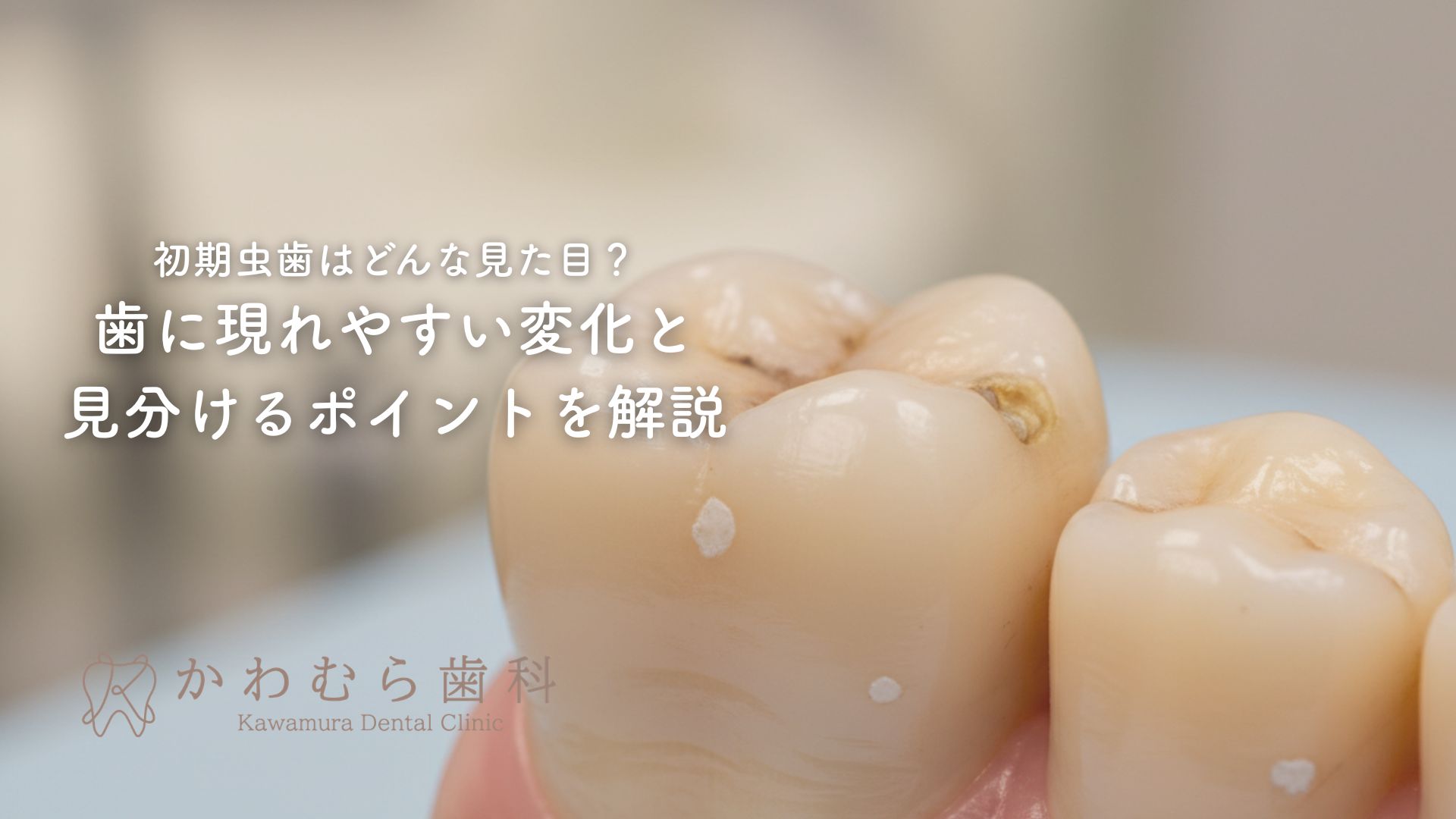 初期虫歯はどんな見た目？歯に現れやすい変化と見分けるポイントを解説