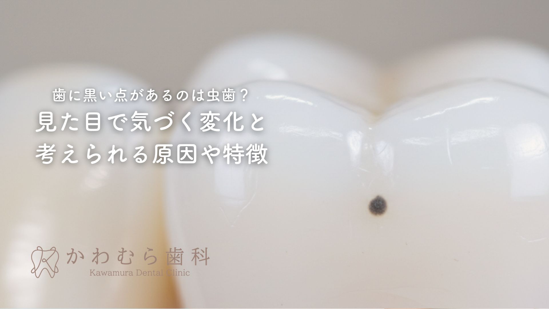 歯に黒い点があるのは虫歯？見た目で気づく変化と考えられる原因や特徴